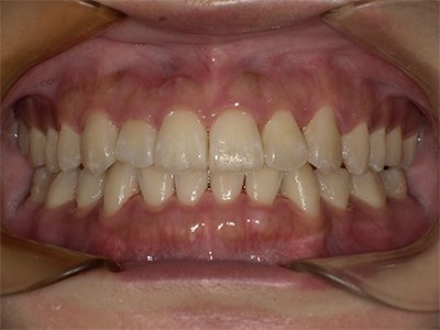 下顎前突 治療後写真