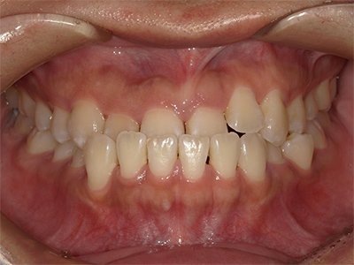 下顎前突 治療前写真