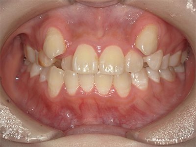 叢生／交叉咬合 治療前写真