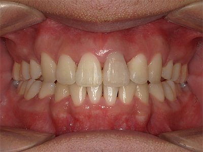 叢生／交叉咬合 治療後写真