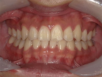 叢生／交叉咬合 治療後写真