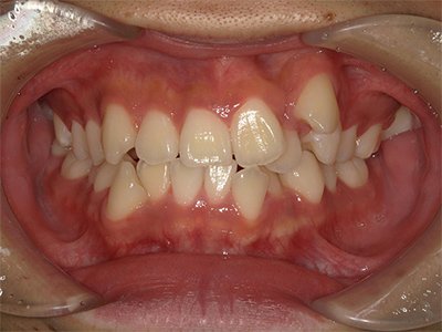 叢生／交叉咬合 治療前写真