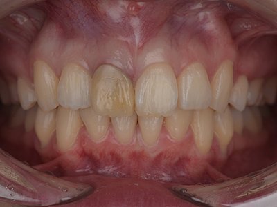 上顎前突 治療後写真