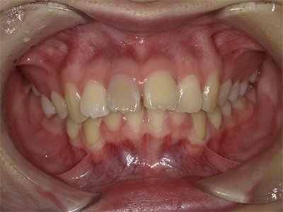 上顎前突 治療前写真