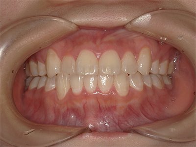 叢生／交叉咬合 治療後写真