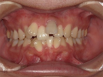 叢生／交叉咬合 治療前写真