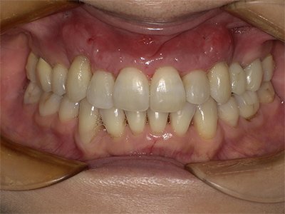 叢生 治療後写真