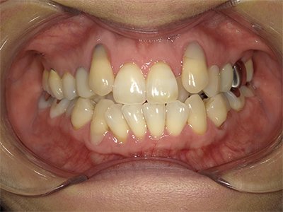 叢生 治療前写真