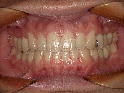 叢生 治療後写真