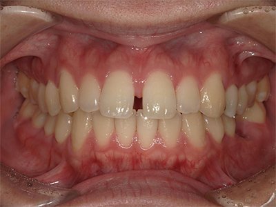 叢生 治療前写真