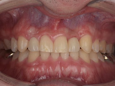 叢生 治療後写真