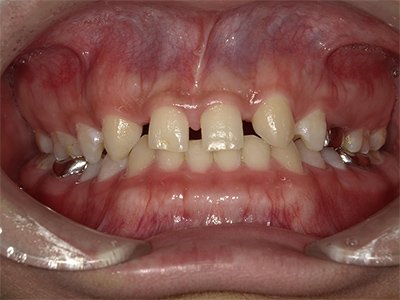 叢生 治療前写真