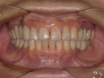 叢生 治療後写真