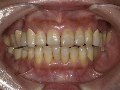 叢生 治療前写真