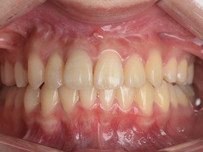 上顎前突 治療後写真