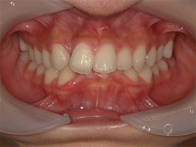 上顎前突 治療前写真