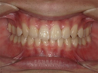 過蓋咬合 治療後写真