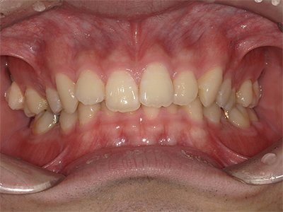 過蓋咬合 治療前写真