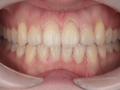 叢生 治療後写真