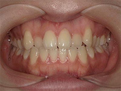 叢生 治療前写真